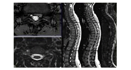 척추 자기 공명 영상(Spine Image) 이미지